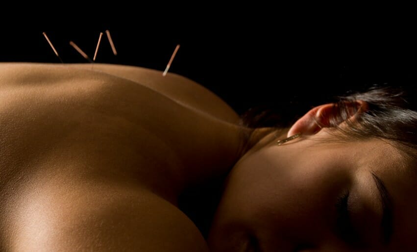 L'acupuncture pour maigrir