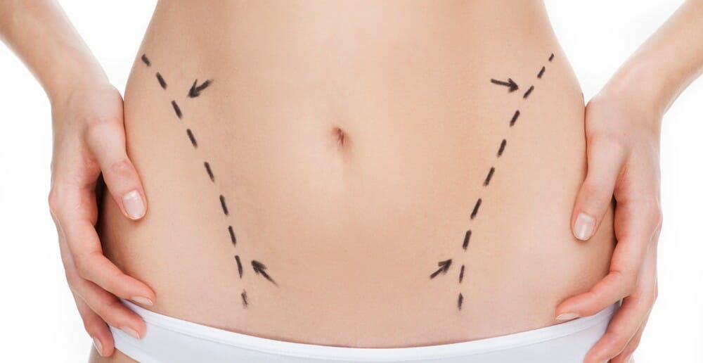 La chirurgie esthétique pour maigrir