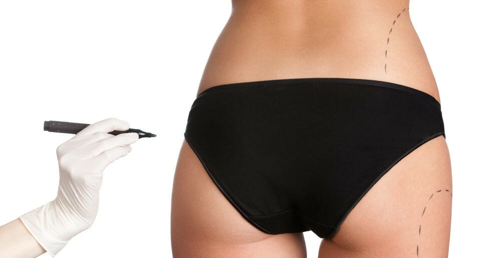 La liposuccion fait-elle perdre du poids ?