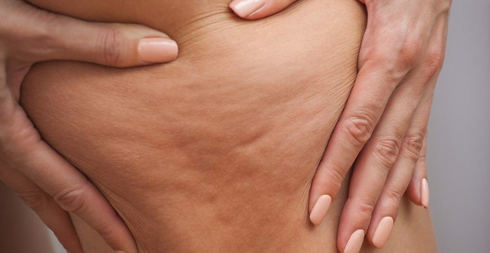 Le drainage lymphatique pour lutter contre la cellulite