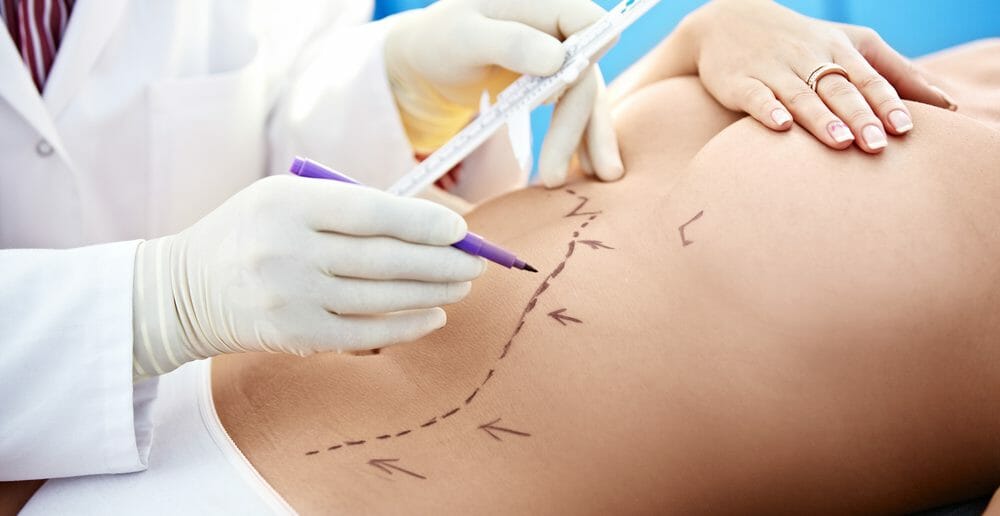 La liposuccion pour perdre la graisse abdominale