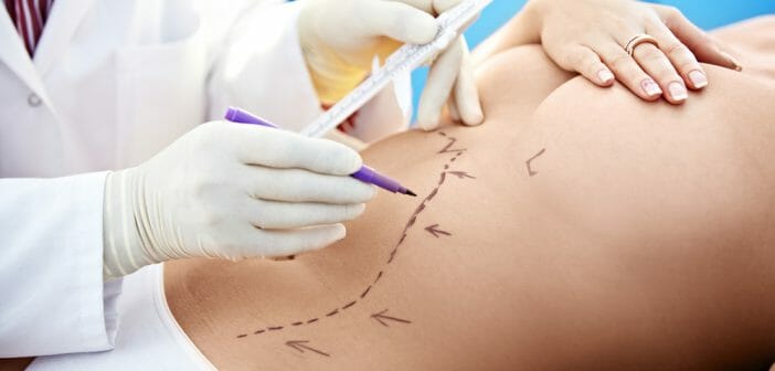 La liposuccion pour perdre la graisse abdominale