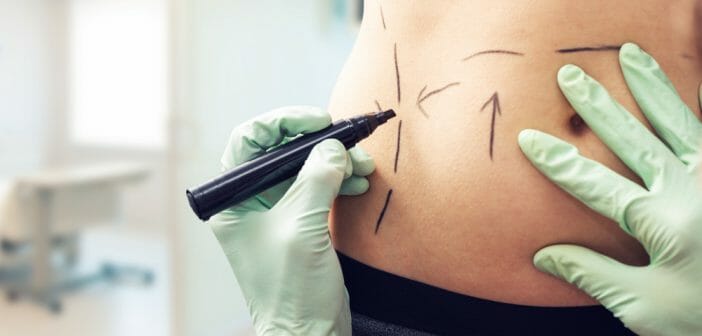 La chirurgie pour perdre des hanches